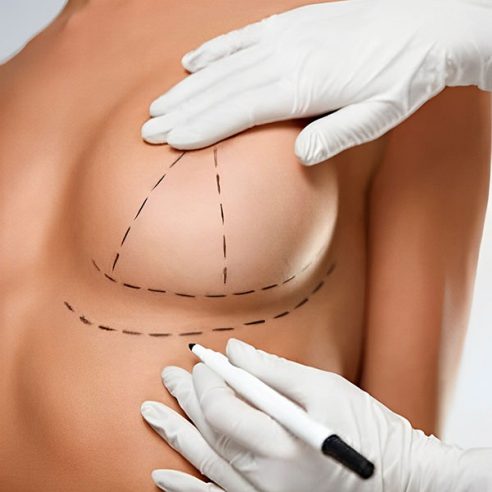 lenvamiento de mamas