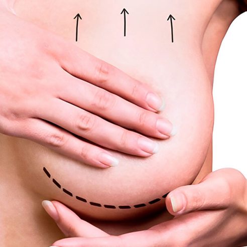 levantamiento de mamas