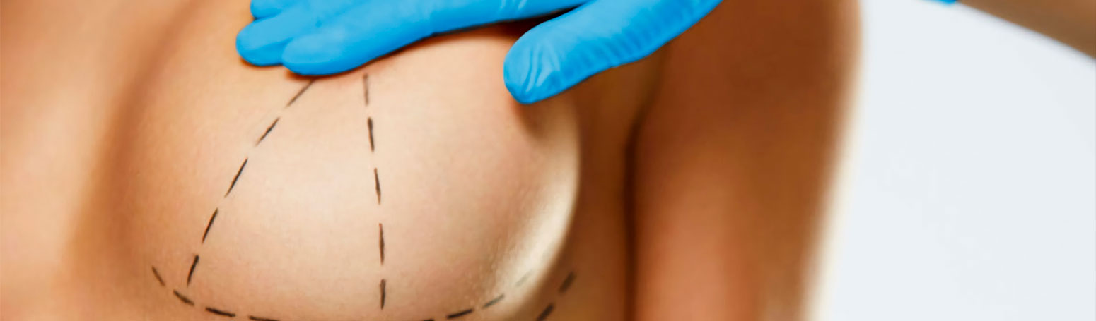 Levantamiento de mamas