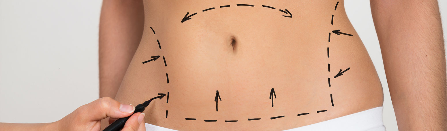 Lipoescultura y Lipotransferencia Glutea