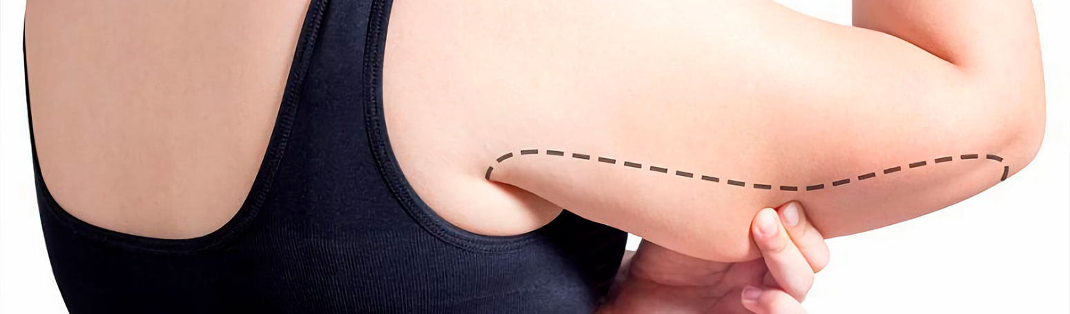 Liposucción de brazos