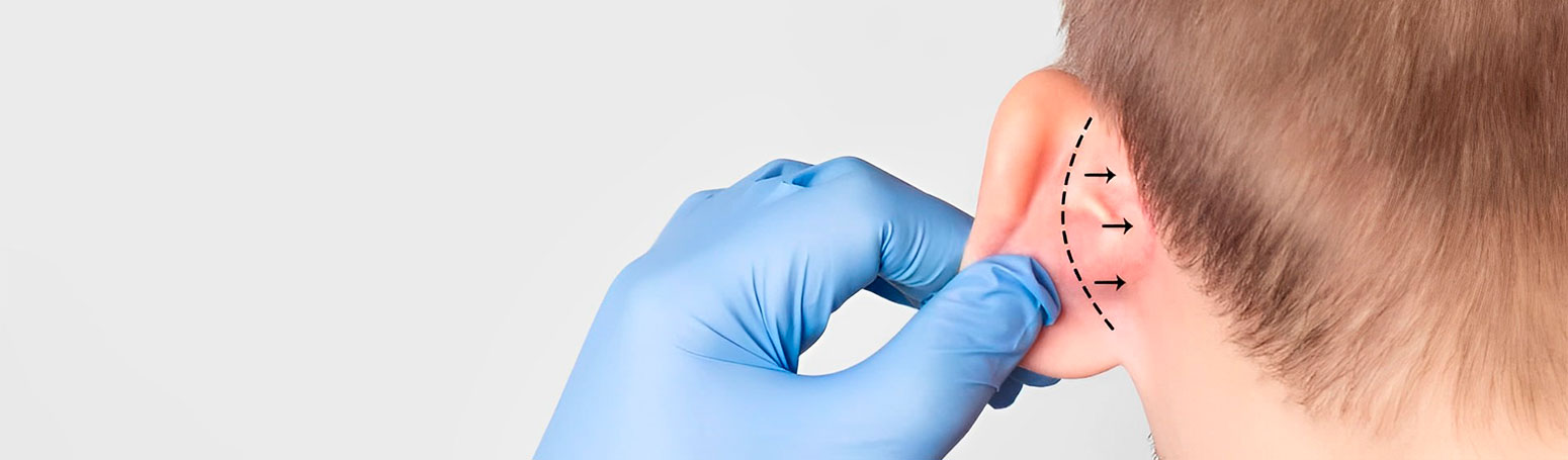 otoplastía